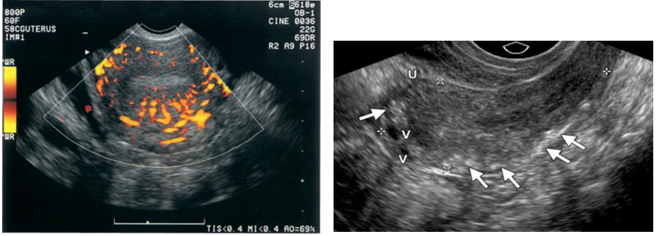 <p> <strong><em>Myomas are the most common cause of uterine calcifications</em></strong>.</p><p class="p1"> <strong><em>A less common cause is arcuate artery calcification in the periphery of the uterus</em></strong>.</p><p class="p1"> These calcifications are thought to occur as a consequence of calcific sclerosis within these vessels</p><p class="p1">and <strong><em>can indicate underlying diseases, such as diabetes mellitus, hypertension, and chronic renal</em></strong></p><p class="p1"><strong><em>failure. </em></strong>Such calcifications have been termed Monckeberg arteriosclerosis and appear in arteries</p><p class="p1">throughout the body.</p><p class="p2"> <strong>Sonographic Findings</strong>:</p><p class="p2">➢ Focal areas of increased echogenicity</p><p class="p2">➢ Shadowing</p><p class="p2">➢ Peripheral echogenic rim.</p>