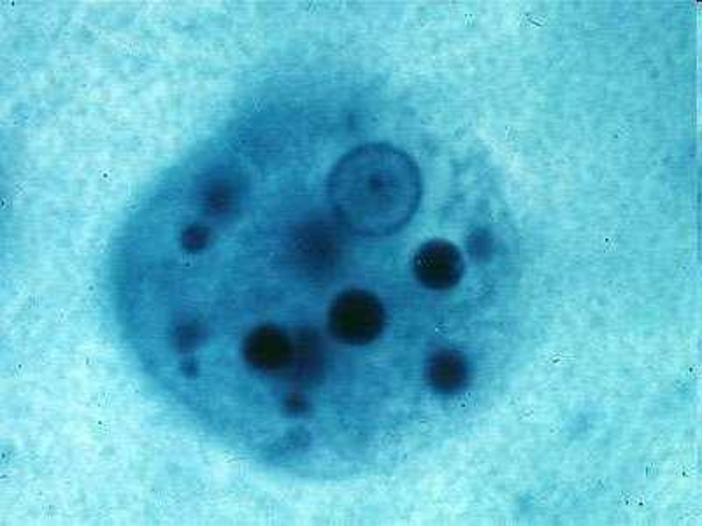 <p>Crystals indicating eosinophilic response, found in stool.</p>
