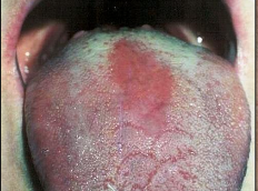 <p>What is median rhomboid glossitis?</p>