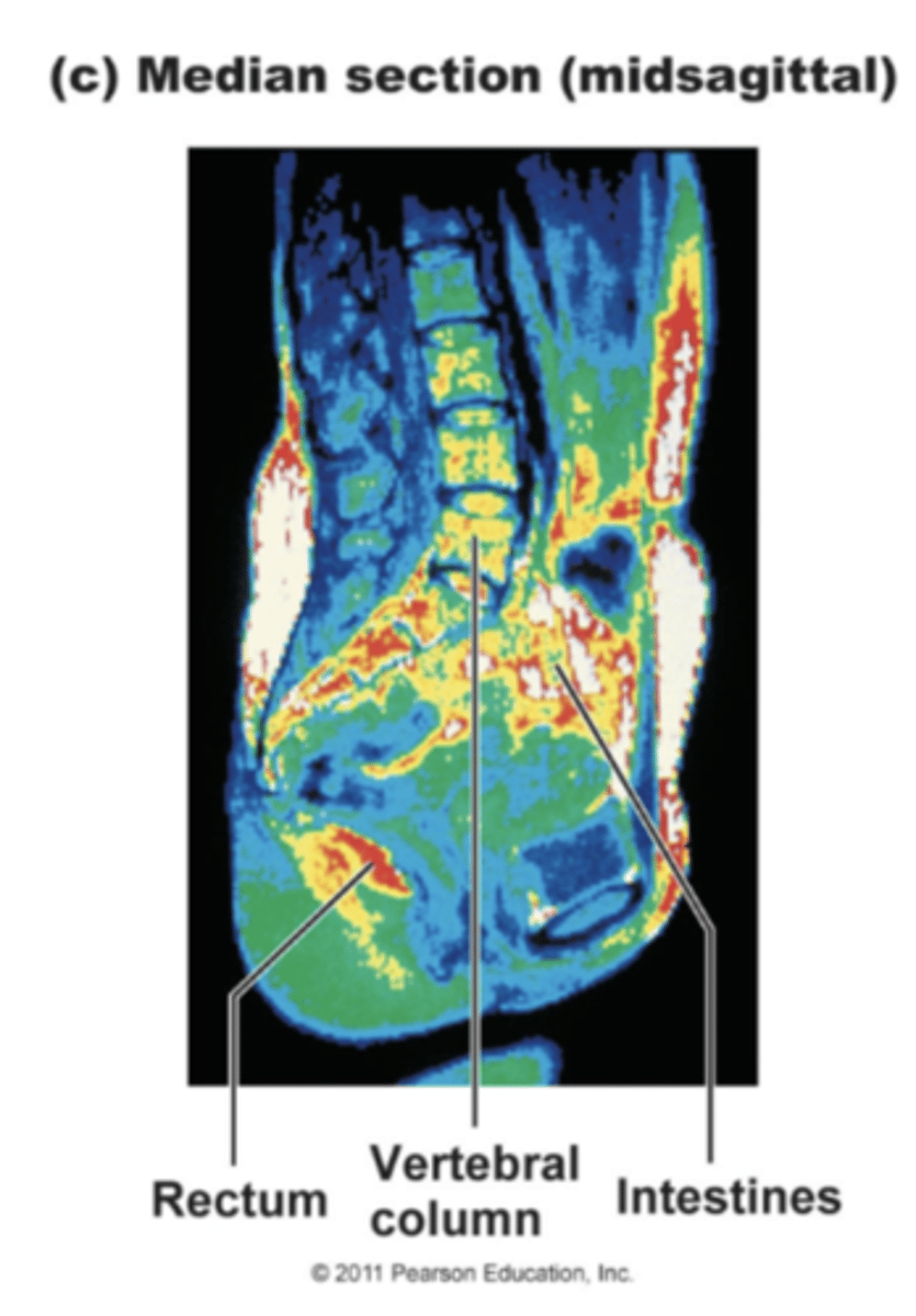 <p>A sagittal, median or midsagittal plane is cut down the long length of the body. The body is split into right and left halves. If the plane is exactly in the center, then it is considered to be midsagittal.</p>