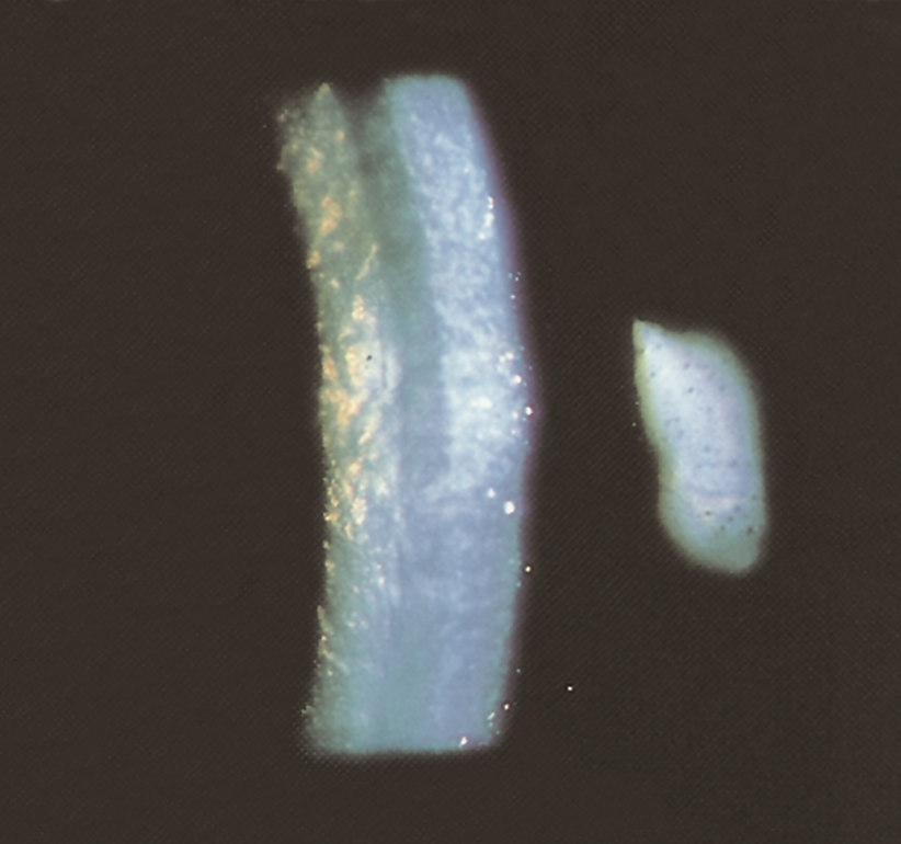 (stromal oedema, Descemet folds and endothelial guttae)