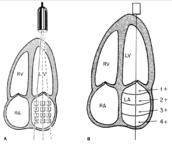 <ul><li><p>Grade 1 - mild (with leaking just beyond the mitral valve leaflets)</p></li><li><p>Grade 2 - moderate (leaking in the proximal 1/3 way into LA)</p></li><li><p>Grade 3 - mod/severe (leaking halfway into LA)</p></li><li><p>Grade 4 - severe (leaking to the backwall of the LA all the way into the pulmonary vein(s))</p></li></ul>