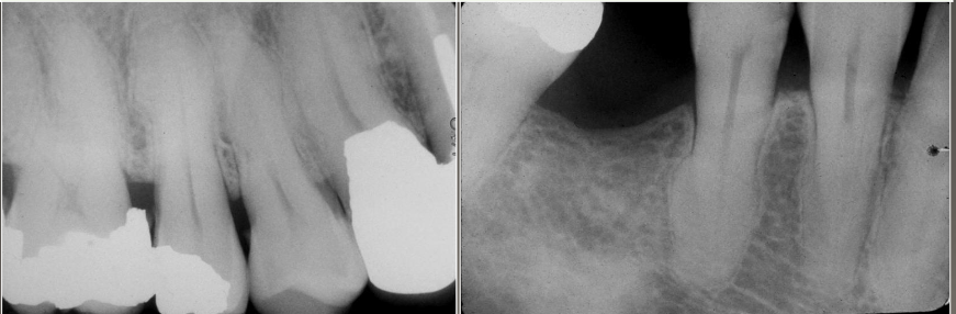 <ul><li><p class="">Abnormal occlusal trauma.</p></li><li><p class="">Adjacent inflammation.</p></li><li><p class="">Unopposed teeth (super eruption).</p></li><li><p class="">Repair of vital root fracture.</p></li></ul><p></p>