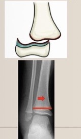 <p>Use the Salter-Harris classification system to describe the fracture pattern</p>