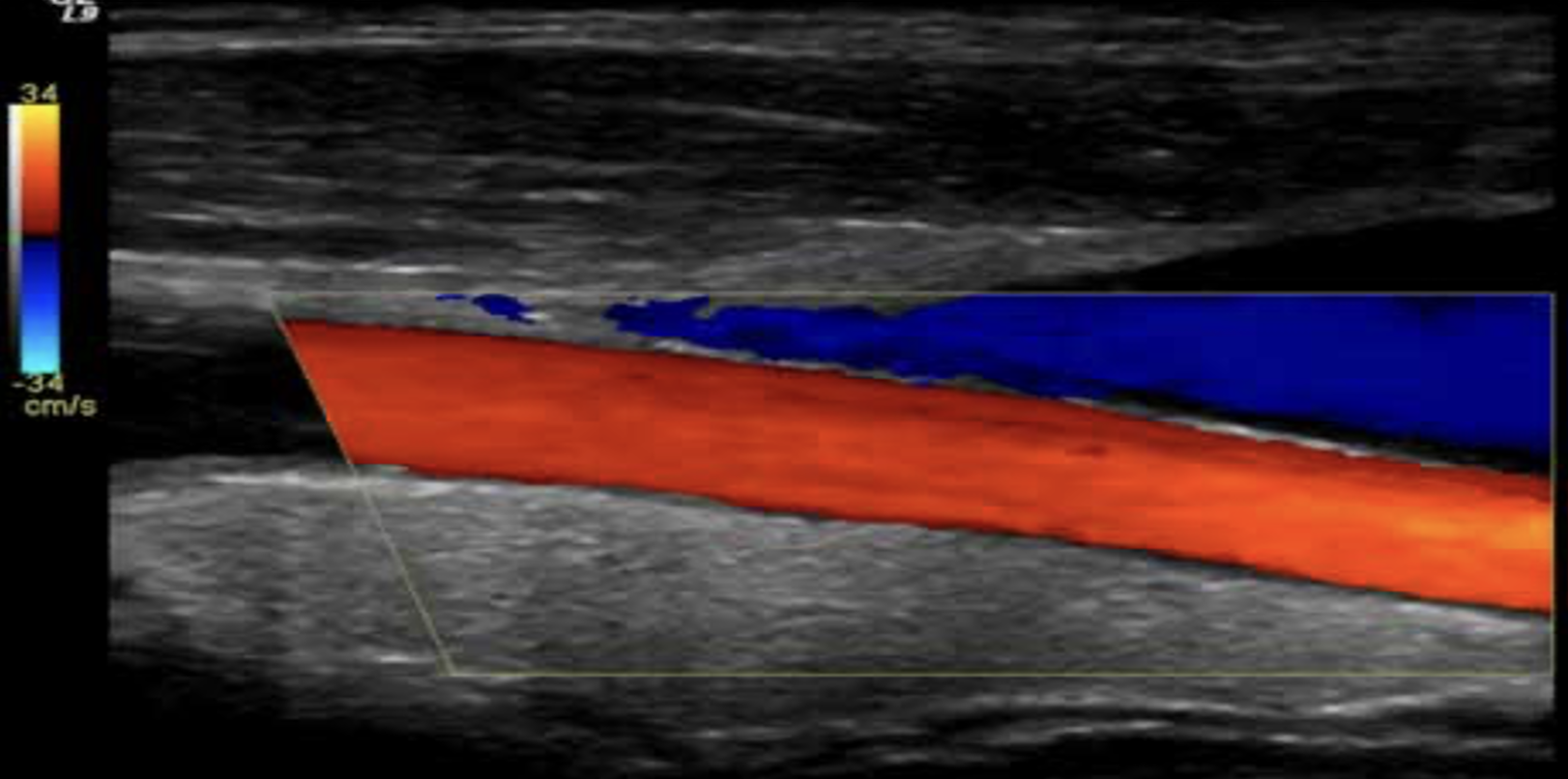 <ul><li><p>shows blood flow motion in a selected two-dimensional area.&nbsp;</p></li></ul><ul><li><p>shows Direction and velocity blood flow.</p></li><li><p>direction and blood flow are color coded and superimposed on the corresponding B-mode image</p></li></ul><p></p>