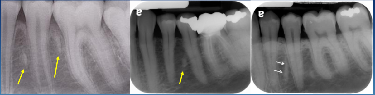 <ul><li><p>has a thin RL rim or PDL space (sometimes, this is when it harder to distinguish it between DBI) </p></li><li><p>long oval shape </p></li><li><p>pulp canal sometimes visible </p></li></ul><p></p>