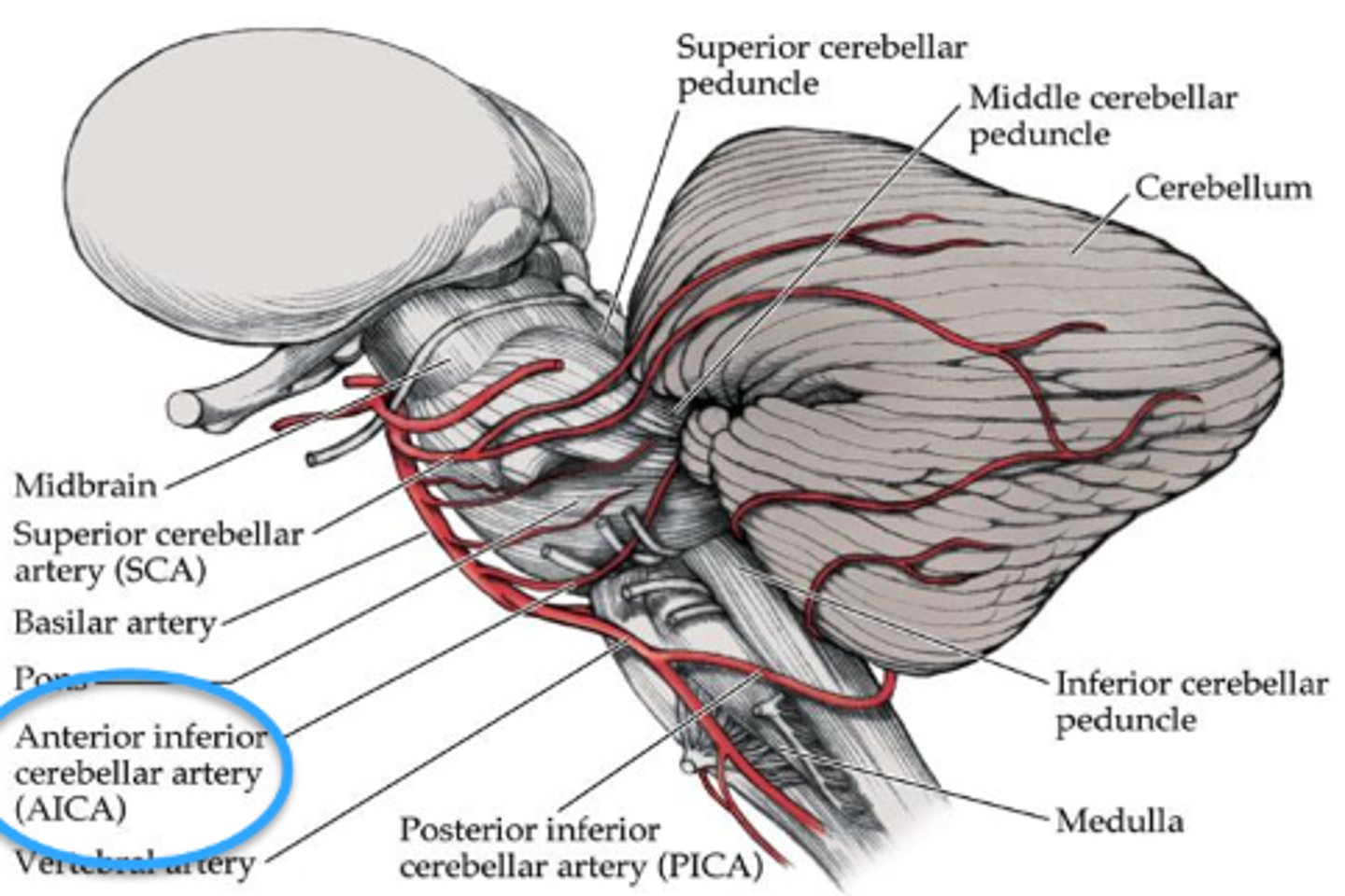 <p>lesion in the anterior inferior cerebellar artery</p>
