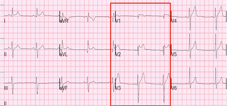 <p>saddle shape ST elevation in V1-3 (carousel horses sign)</p>