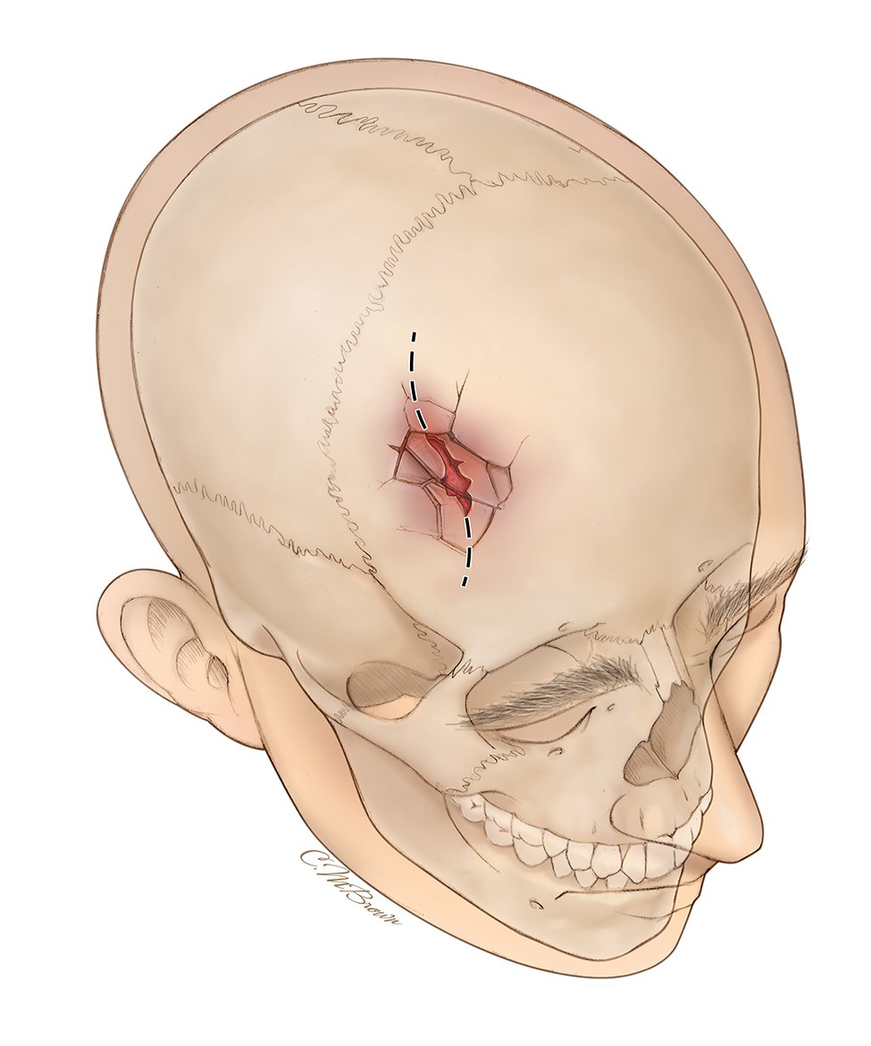 <p>Broken bone portion is pressed inward</p>