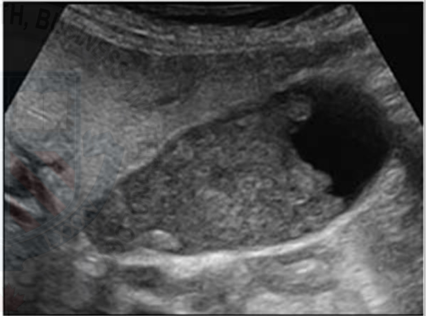 <p>Mass-like sludge; mimics neoplasm </p><p>Non-mobile Echogenic mass; no shadowing </p>