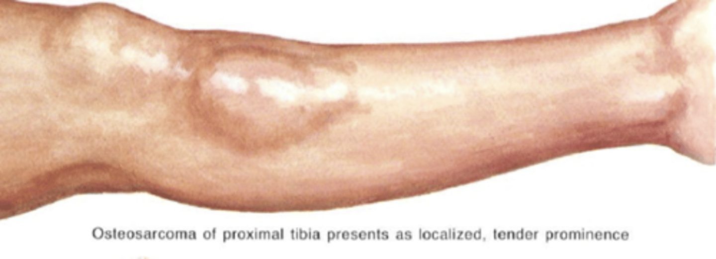 <p>State the clinical findings of osteosarcoma</p>