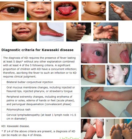 <ul><li><p class=""><strong>Acute systemic vasculitis</strong></p></li><li><p class=""><strong>Unknown etiology</strong></p></li><li><p class="">More common in <strong>boys</strong> than girls</p></li><li><p class=""><strong>80–90%</strong> of cases occur in children <strong>&lt;5 years old</strong></p></li><li><p class=""><strong>Higher prevalence in children of Asian ancestry</strong></p></li><li><p class=""><strong>Widespread inflammation</strong> of medium-sized muscular arteries</p></li></ul><p><strong>Symptoms:</strong></p><ul><li><p class=""><strong>Fever for 5 or more days</strong> along with:</p><ul><li><p class="">Strawberry tongue</p></li><li><p class=""><u>Cracked, red lips</u></p></li><li><p class="">Cervical lymphadenopathy (usually on one side)</p></li><li><p class="">Redness of palms or soles</p></li><li><p class="">Edema of hands or feet</p></li><li><p class=""><u>Generalized rash</u></p></li><li><p class="">Bilateral bulbar conjunctival injection (without exudate)—pink eye w/ no drainage</p></li></ul></li></ul><p><strong>Course &amp; Complications:</strong></p><ul><li><p class="">Self-limiting, typically resolves in &lt;8 weeks</p></li><li><p class=""><strong>Potential complications:</strong></p><ul><li><p class=""><strong>Coronary artery abnormalities</strong></p></li><li><p class=""><strong>Long-term risks:</strong> heart failure, myocardial infarction, arrhythmias</p></li><li><p class="">Aneurysms</p></li></ul></li></ul><p><strong>Diagnosis:</strong></p><ul><li><p class="">Patient must have at least <strong>4 out of 5 criteria</strong> from different symptom categories.</p></li></ul><p></p>