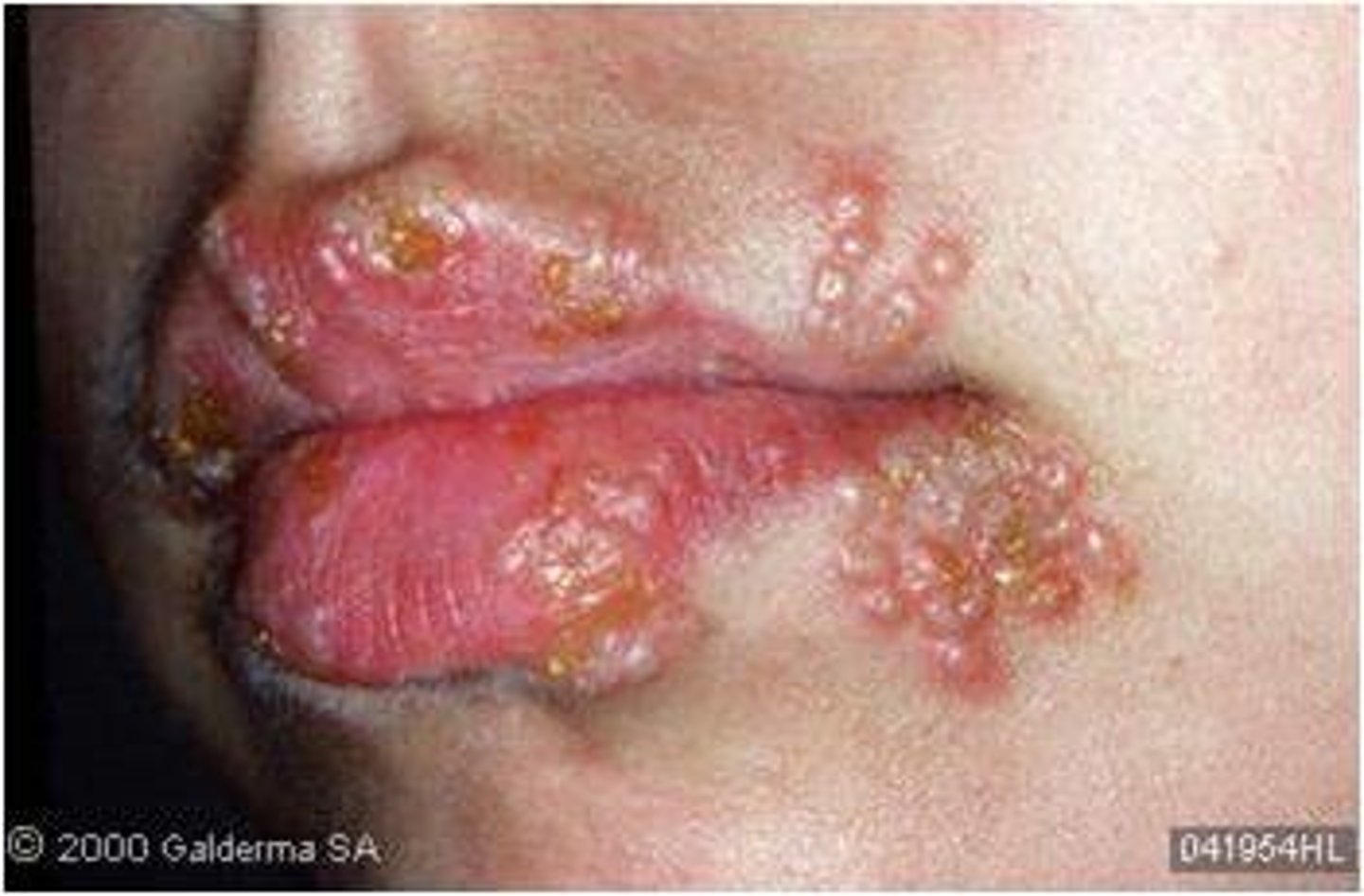 <p>Herpes simplex virus (usually type 1)</p>