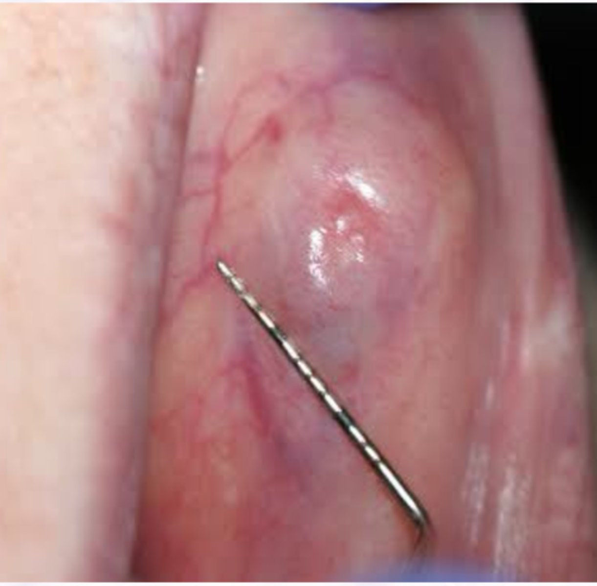 <p>Malignant Salivary Gland Tumors: </p><p>-Tumor of the minor salivary glands</p><p>-6th -8th decades of life</p><p>-Female predilection</p><p>-Painless slow growing lesion</p><p>-Almost exclusively in minor salivary glands</p><p>-May infiltrate bone</p>