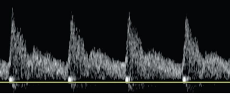 <p>flow patterns with _____________:</p><ul><li><p>energy stored in the distended artery overcomes the low resistance downstream</p></li><li><p>forward flow occurs throughout the cardiac cycle</p></li></ul>