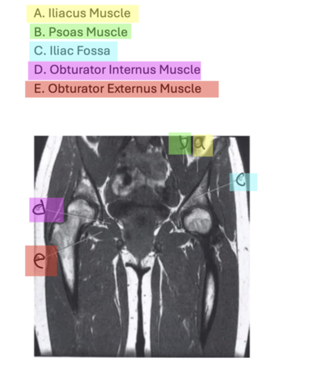 <p>A. Iliacus Muscle</p><p>B. Psoas Muscle</p><p>C. Iliac Fossa</p><p>D. Obturator Internus Muscle</p><p>E. Obturator Externus Muscle</p>