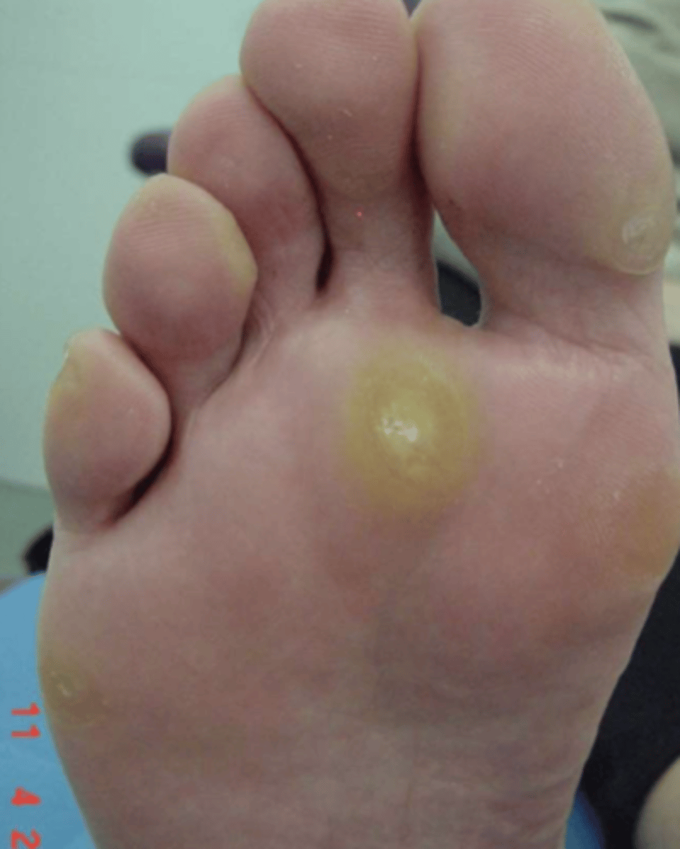 <p>¿lesión?</p><p>¿primaria o secundaria?</p>