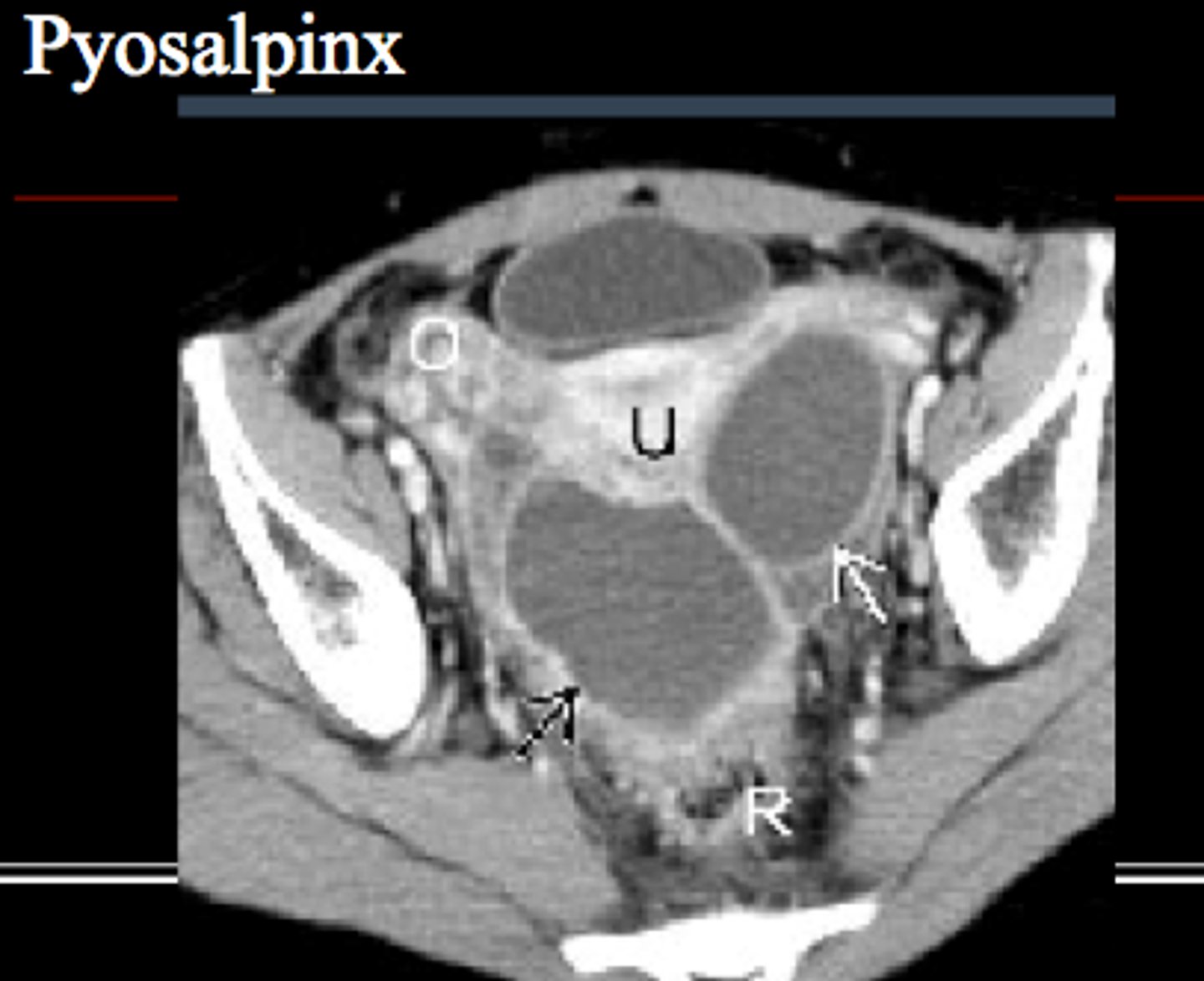 <p>pus in the fallopian tube</p>