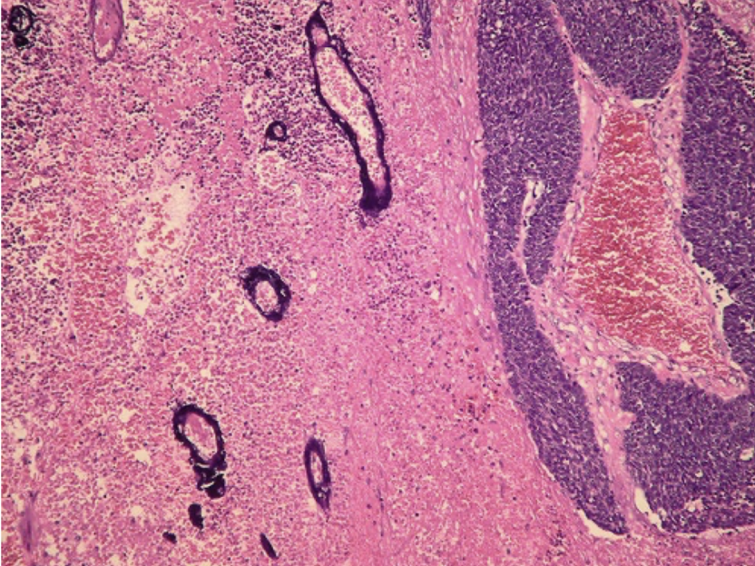 <p>lots of necrosis with azzopardi effect</p>