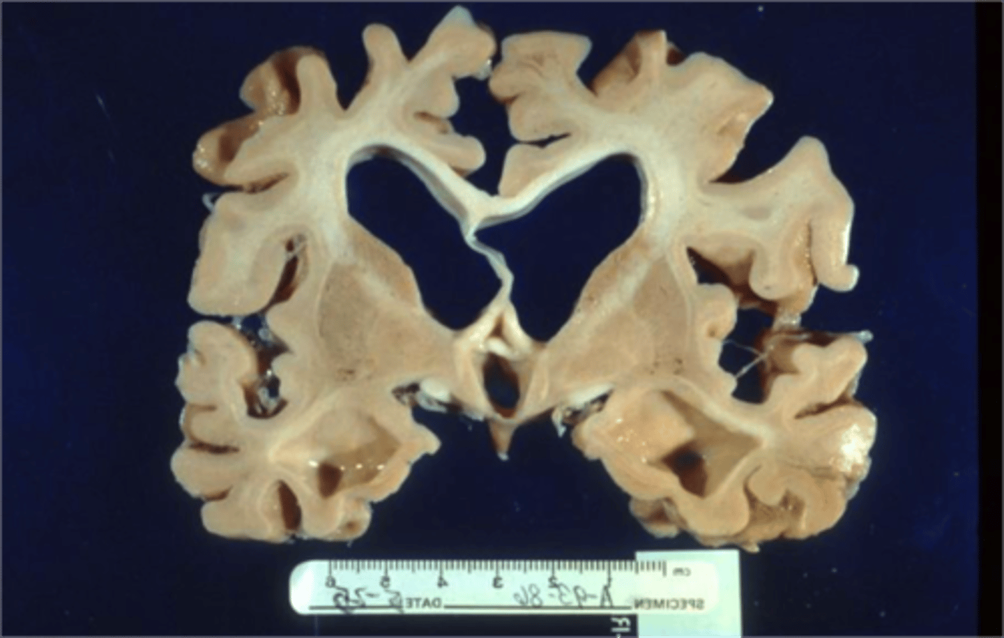 <p>large spaces develop inside cortex due to loss of cortical tissue - 'cortical atrophy' seen in dementia; NOT really hydrocephalus, atrophy is incited.</p>