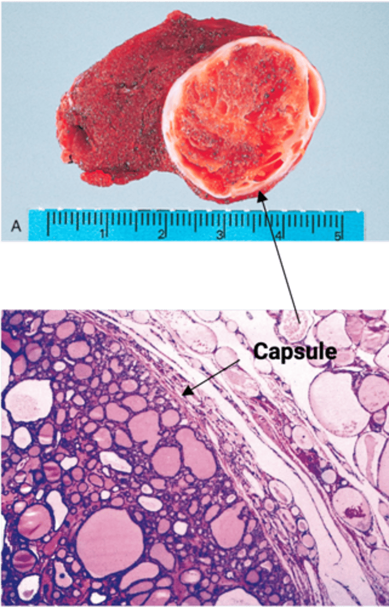 <p>Define Condition:</p><p>MC Benign Thyroid Neoplasm (proliferation of thyroid follicles)</p><p>-Sx/PE: Solitary NONPAINFUL nodule (most non-functional, but functional = toxic adenoma)</p><p>-Dx:</p><p>&gt; Gross = Solitary nodule w/ well-defined intact capsule</p><p>&gt; Micro = Thyroid tissue completely surrounded by fibrous capsule - can't differentiate this from carcinoma b/c entire capulse can't been see in frozen section</p>