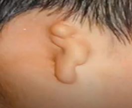 <ul><li><p><strong>Congenital deformity</strong> wherein the pinna is either <strong>small, abnormally shaped, or absent</strong></p></li><li><p>Can occur on just one side or on both</p></li></ul><p></p>