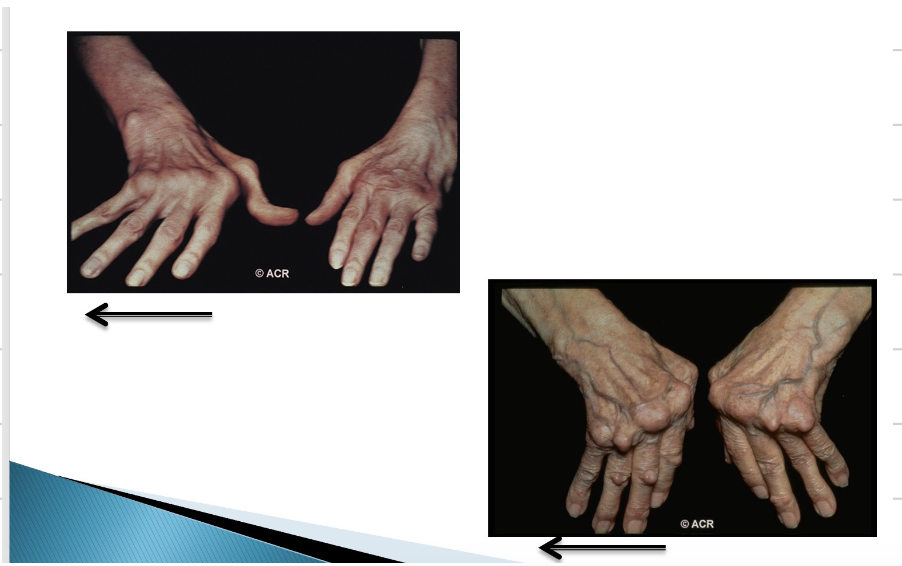 <img src="https://knowt-user-attachments.s3.amazonaws.com/bc203458-3896-4aff-9053-eda4e82f791c.png" data-width="50%" data-align="center" alt="knowt flashcard image"><p><mark data-color="#ffb6e8" style="background-color: #ffb6e8; color: inherit">RA causes different deformities of the joint. Explain what is seen in the following image.</mark></p>