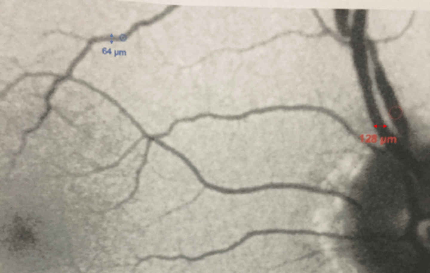 <p>small = smaller than 64 micron diameter of a macular venule</p><p>intermediate = between 64-128 microns</p><p>large = larger than 128 micron diameter of a vein near ONH</p>