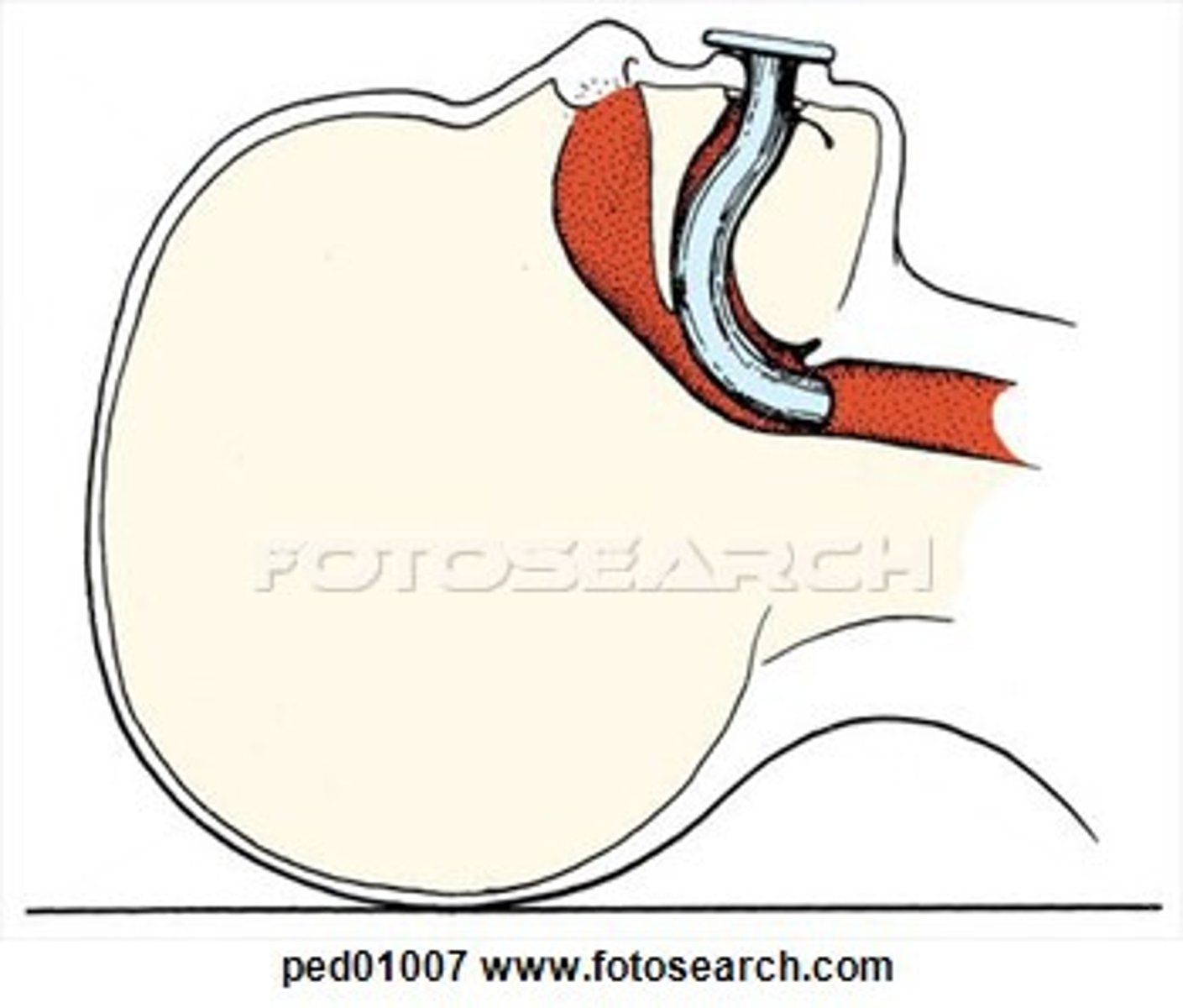 <p>A curved plastic device inserted into the patient's mouth to minimize obstruction of the airway caused by the tongue</p>