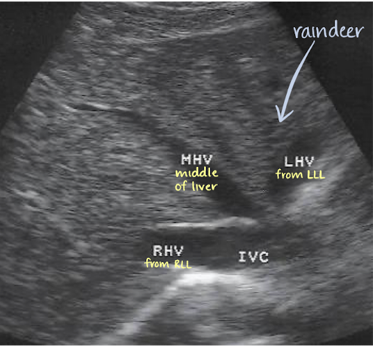 <p>returns deoxygenated blood from liver into IVC</p>