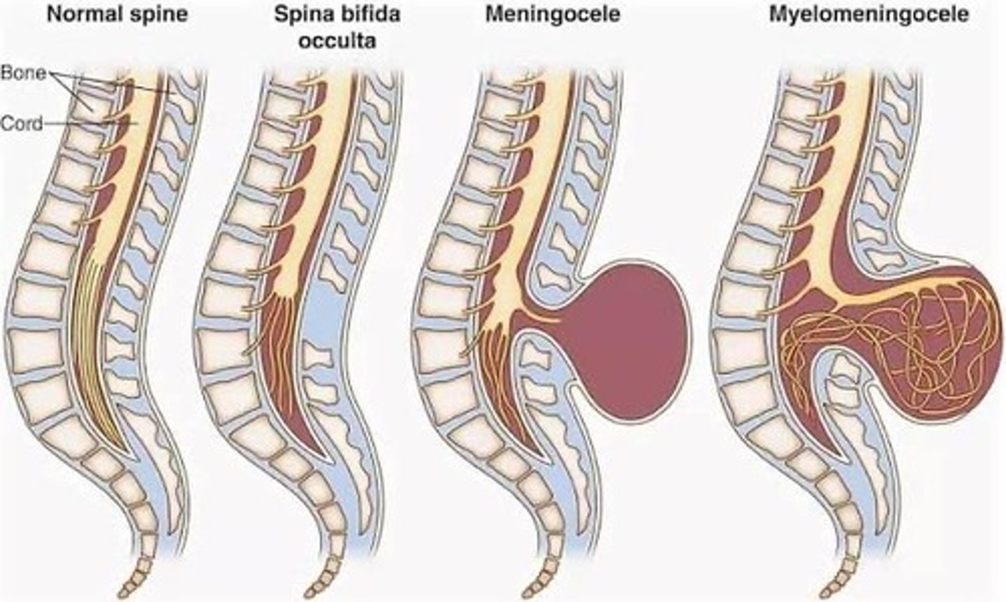 <p>- spina bifida occulta</p><p>- meningocoele</p><p>- spina aperta -> meningomyelocoele</p>