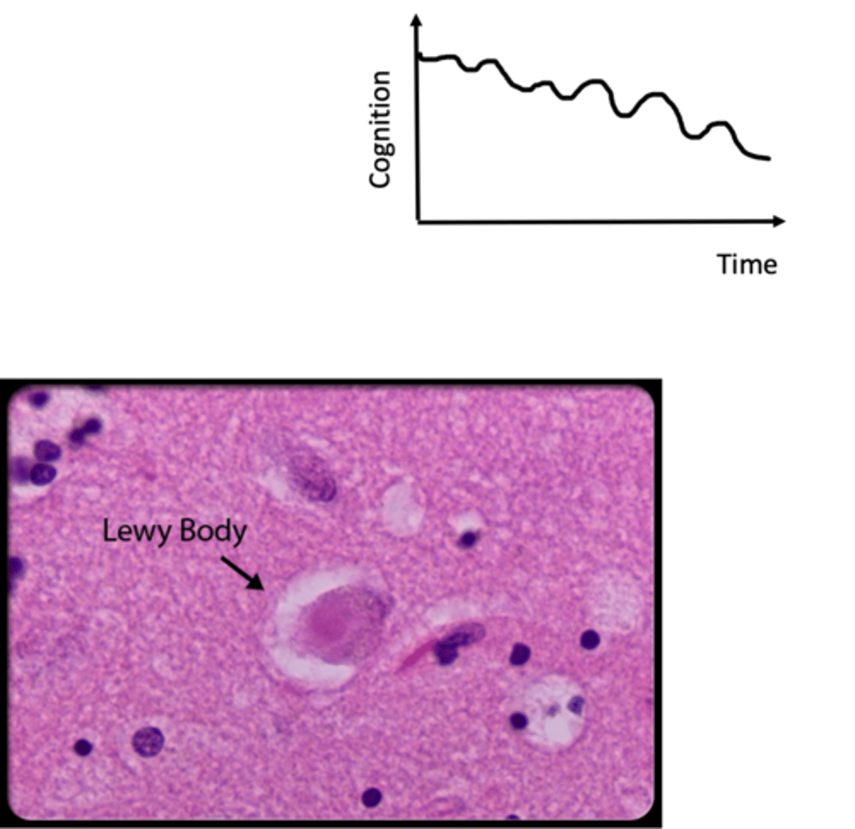 <p>- Parkinsonism (tremor, bradykinesia, rigidity)</p><p>- Fluctuating cognitive impairment</p><p>- Visual hallucinations</p><p>- Delusions</p><p>- Falls</p><p>- Sleep disturbance</p>