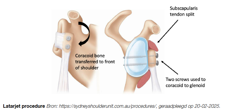 <ul><li><p>conservatief: trainen van de rotator cuff spieren. Deze spelen een rol bij het stabiliseren van de humeruskop op het glenoid.</p></li><li><p>De geluxeerde schouder moet eerst rustig worden terug gezet, dit kan alleen door de spieren er omheen te ontdpannen, soms met medicatie.</p></li><li><p>altijd letten op plexus brachialis!</p></li></ul><p></p><ul><li><p>Andere optie is<strong> Bankart repair: </strong>artheroscopische schouderstabilisatie. Hierbij wordt het voorste deel van het labrum weer aan de glenoid gefixeerd. Hierbij wel 25% kans recidief, dit is veel kleiner dan zonder operatie.</p></li><li><p><strong>Latarjet</strong>: deze ingreep wordt stuk van processus coracoideus verwijderd en aan de voorkant van het glenoid geplaatst. Herstel duurt maanden en geen volledig krachtherstel.</p></li></ul><p></p>