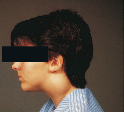 <ul><li><p>brachial cleft cyst</p></li></ul><p></p>