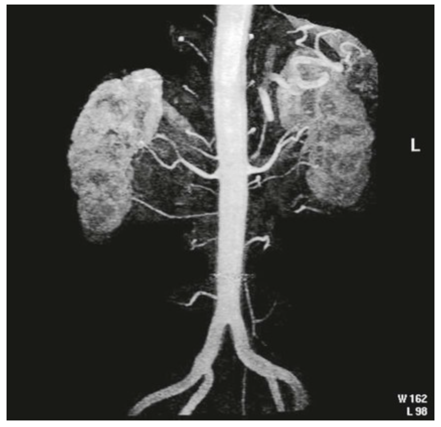 <p><span>A 43-year-old female presents for a routine evaluation prior to a voluntary&nbsp;radical nephrectomy, for donation to a family member. The patient's&nbsp;pre-operative plain film abdominal x-ray demonstrates a potential anomaly. The follow-up&nbsp;magnetic resonance arteriogram confirms what anomaly or variant in this patient? (Image attached)</span></p>