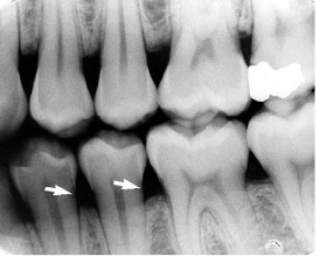 <p>what is indicated by the arrows: a radiolucent area seen at the cervical portion of teeth due to optical illusion, often mistaken for decay</p>