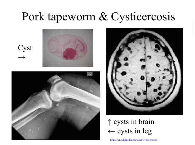 <p>Tapeworm and Cysticercosis</p>
