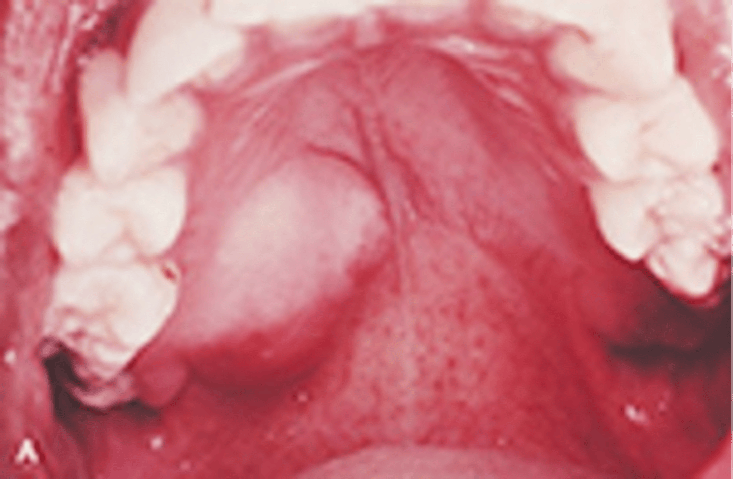 <p>-A benign salivary gland tumor</p><p>-90% of all salivary gland tumors</p><p>-The most common extraoral location is the parotid gland; the most common intraoral location is the palate</p>