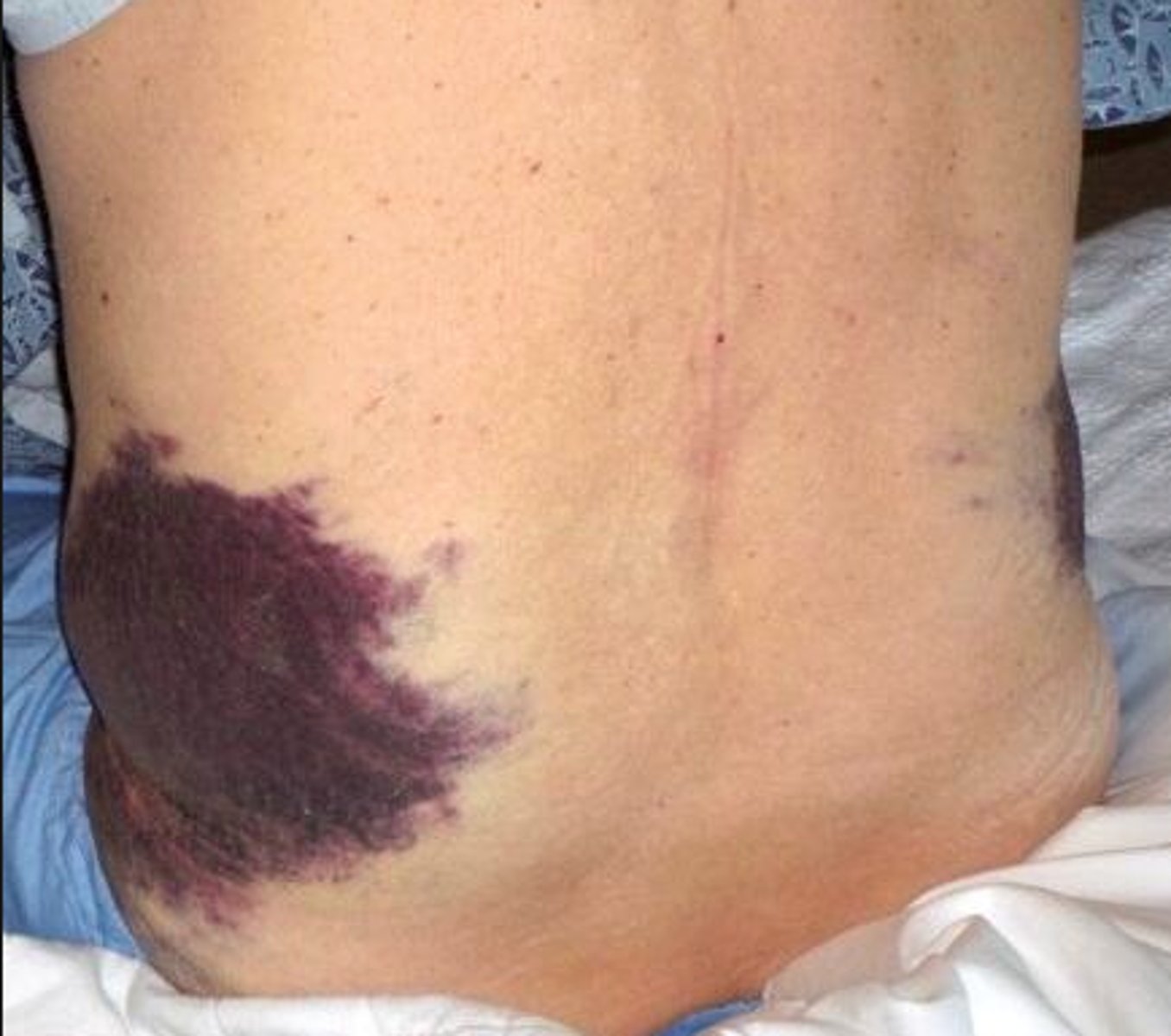 <p>bruising in flank area (lower back area)</p>