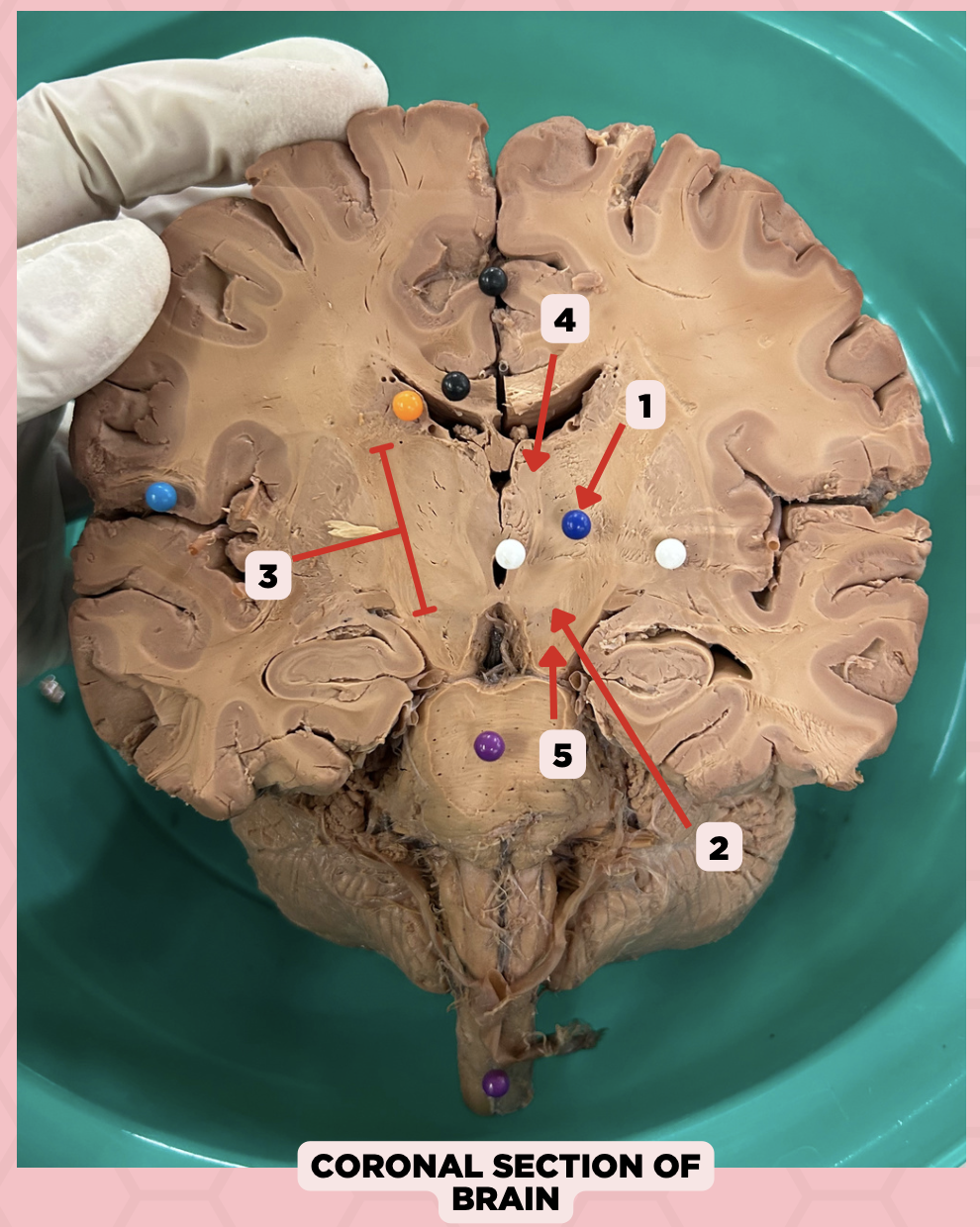 <p>What important structure is found in structure #4?</p><p>a. Pituitary gland</p><p>b. Amygdala</p><p>c. Pineal gland</p><p>d. Hippocampus</p>