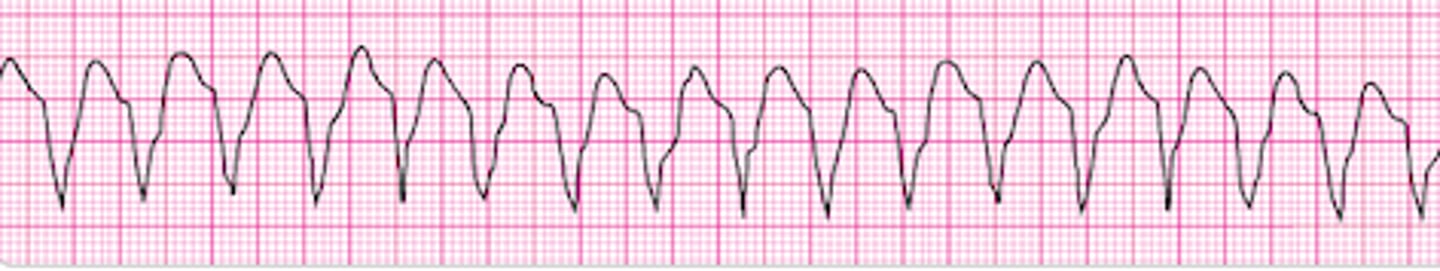 <p>Identify the rhythm.</p>