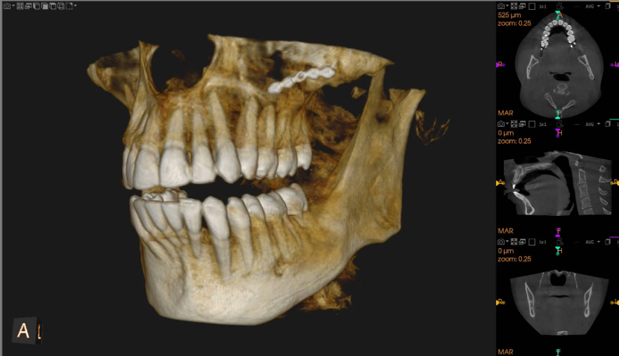 <p>Cone Beam Computed Tomography (CBCT)</p>