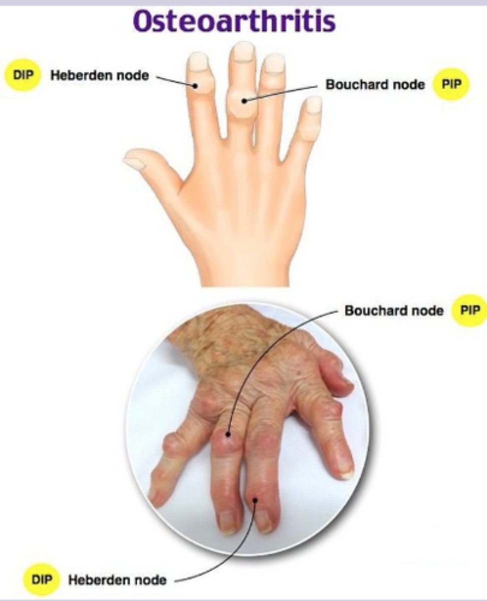 <p>-joint pain: gradual onset, worse with activity, improve with rest</p><p>-morning stiffness lasting less than 30 min </p><p>-joint stiffness goes away after activity slowly </p><p>-may lock or give away </p><p>-NO systemic sx </p><p>-tenderness to palpation along joint lines </p><p>-effusion, muscle atrophy, crepitus </p><p>-Heberden node (DIP), Bouchard node (PIP), square hand deformity </p><p>-varus or valgus deformity in knees</p><p>-limited internal rotation, pain with flexion </p>