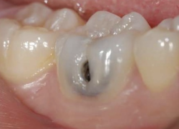 <p>What happens if you have an untreated active moderate lesion?</p>