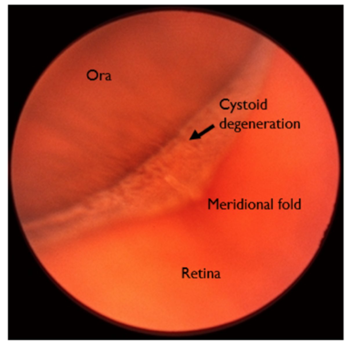 <p>Present in ~100% of eyes over 80 years of age (increases with age)</p><p>• Tiny vesicles with indistinct boundaries on a greyish-white background</p><p>• Usually close to the ora serrata</p><p>• May resemble lattice degeneration -cystoid is elevated while lattice is</p><p>depressed</p><p>• Benign (although possible link with degenerative retinoschisis)</p>