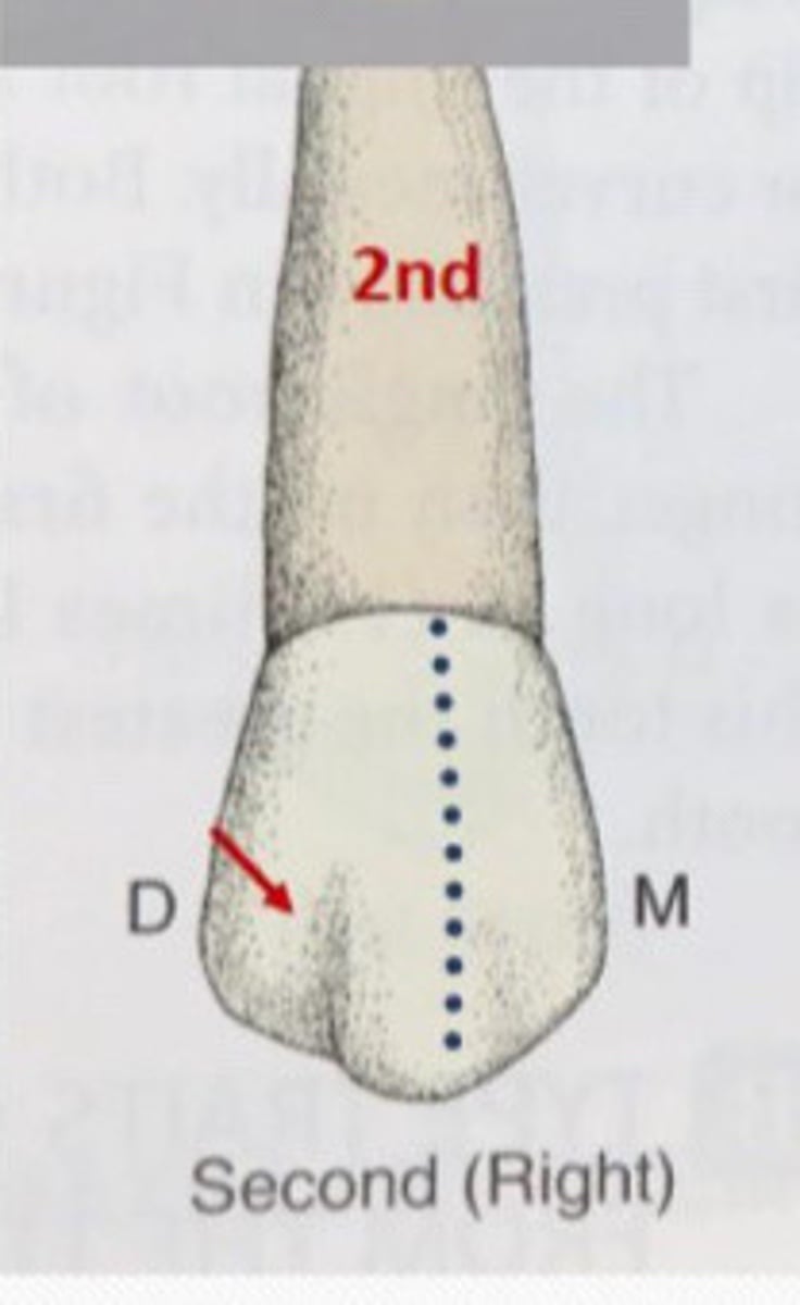 <p>Second premolars ___ ridge depression most common</p>