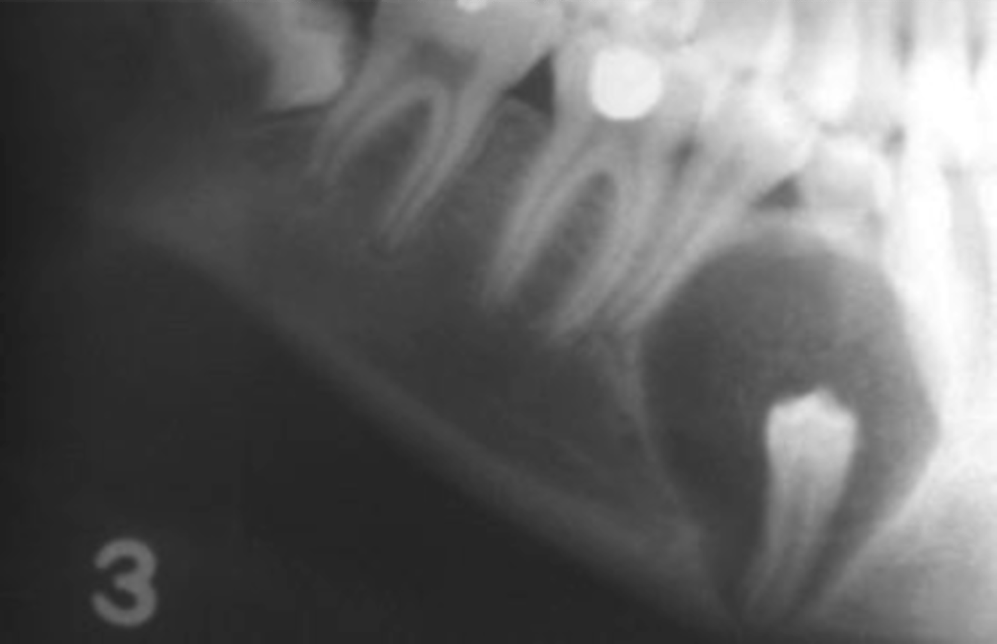 <p>unilocular radiolucency with opaque flecks - "snowflakes"</p>