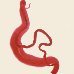 <p>in human blood vessels</p><p>cercarial dermatitis, eosinophilia</p><p>history of long term water exposure</p><p>Africa, Middle East, South America, Caribbean, East Asia, Asia Pacific</p>
