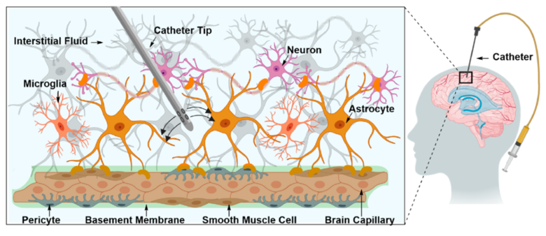 <ul><li><p>Inserting a small diameter catheter into the tumour</p></li><li><p>Anti-cancer drug injected through catheter</p></li></ul><p></p>