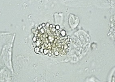 <p>RTE reabsorbed lipids from glomerular filtrate and sloughed off into urine</p><ul><li><p>seen in lipiduria, free fat droplets and/or fatty casts also seen </p></li></ul><p></p>